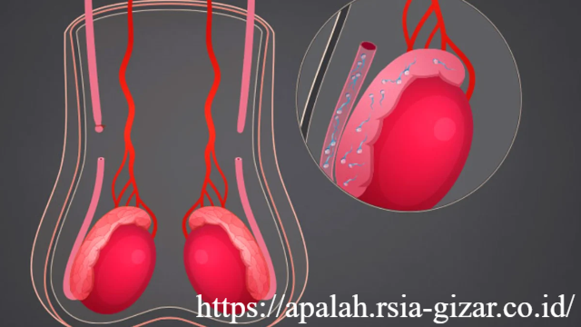 Ramai Pro Kontra Vasektomi Apa Bedanya