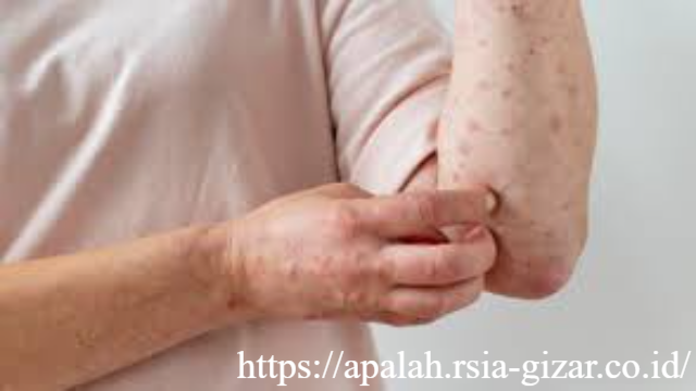 Mengapa Campak pada Orang Dewasa Lebih Berat? Ini Penjelasan Medisnya - Pendahuluan: Campak Bukan Hanya Penyakit Anak Banyak orang menganggap campak sebagai penyakit biasa pada anak-anak. Anggapan ini tidak sepenuhnya salah, tetapi juga tidak sepenuhnya benar. Faktanya, orang dewasa juga bisa terkena campak. Yang lebih mengkhawatirkan, campak pada orang dewasa seringkali berjalan lebih berat dibandingkan pada anak-anak.