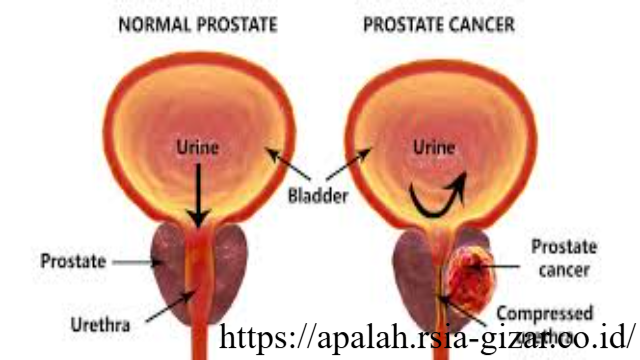 Kanker Prostat dan Kedokteran Nuklir