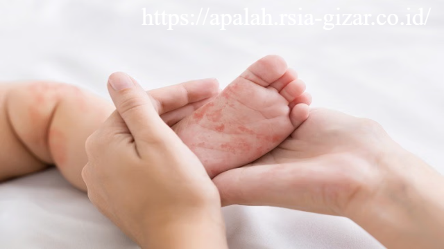 Kena Campak saat Bayi Bocah 7 Tahun Alami Komplikasi